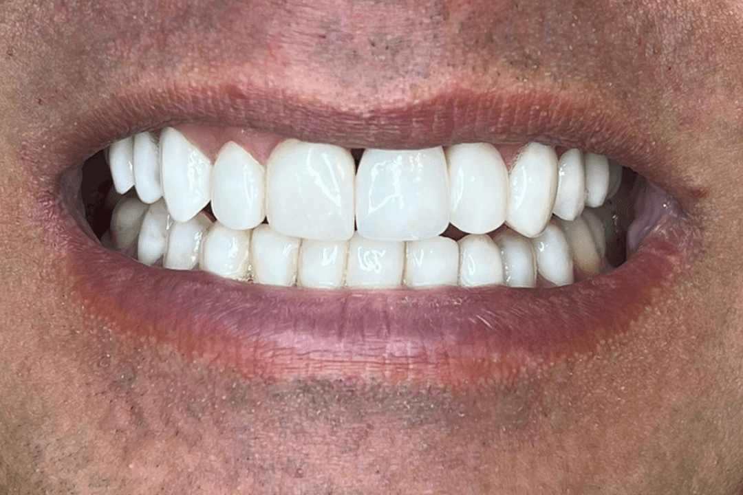 Depois - Faceta de Resina