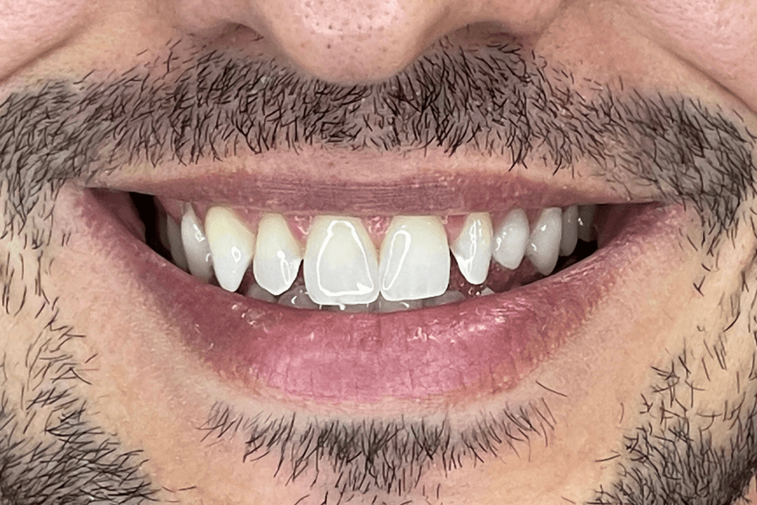 Antes - Faceta de Resina