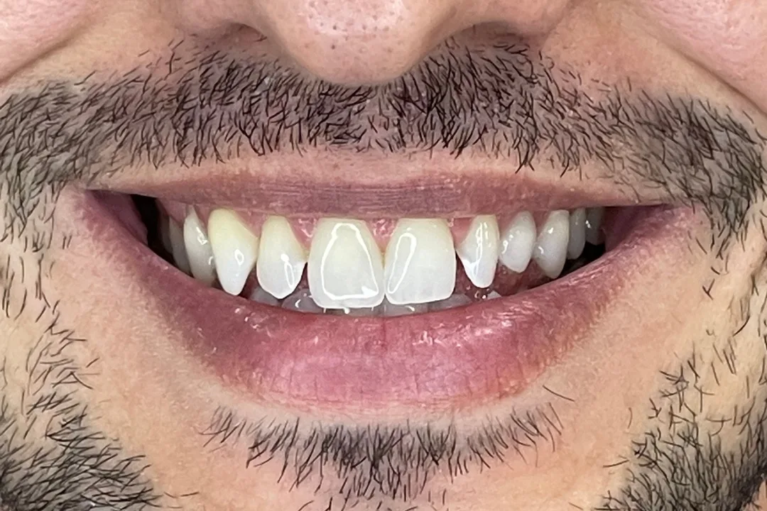 Antes - Faceta de Resina