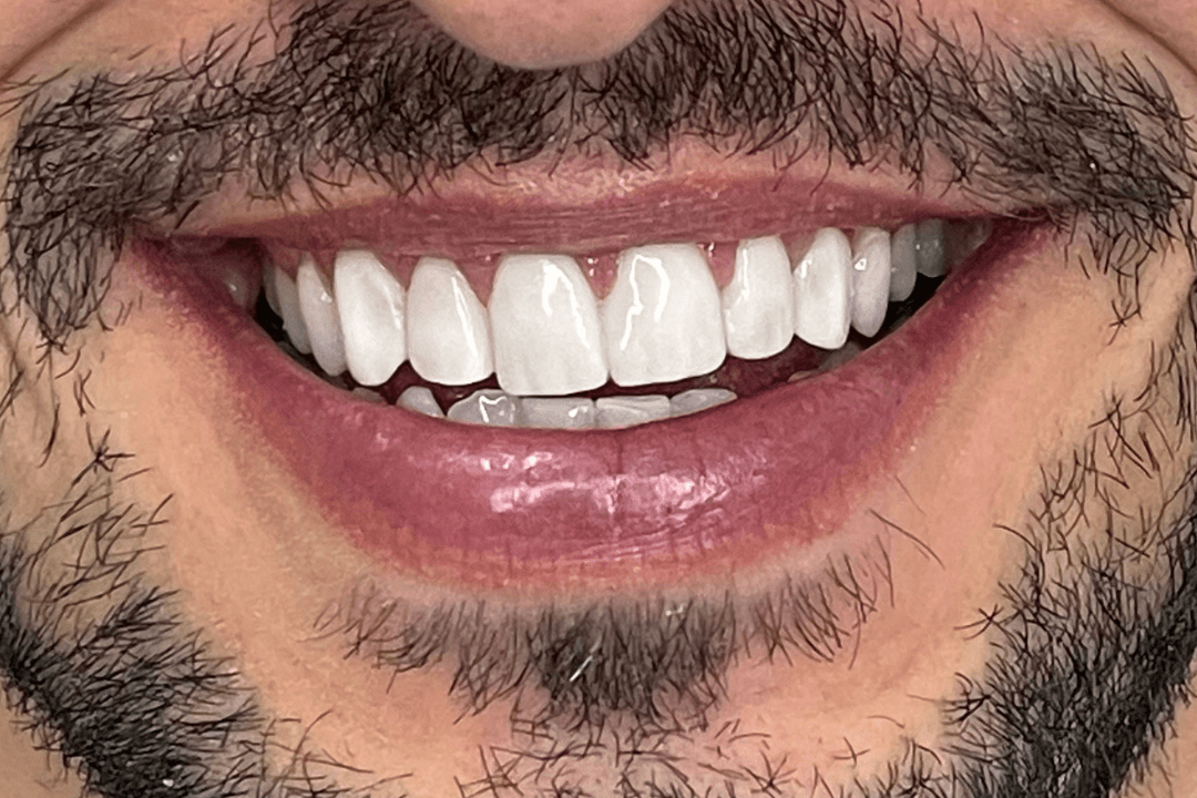 Depois - Faceta de Resina