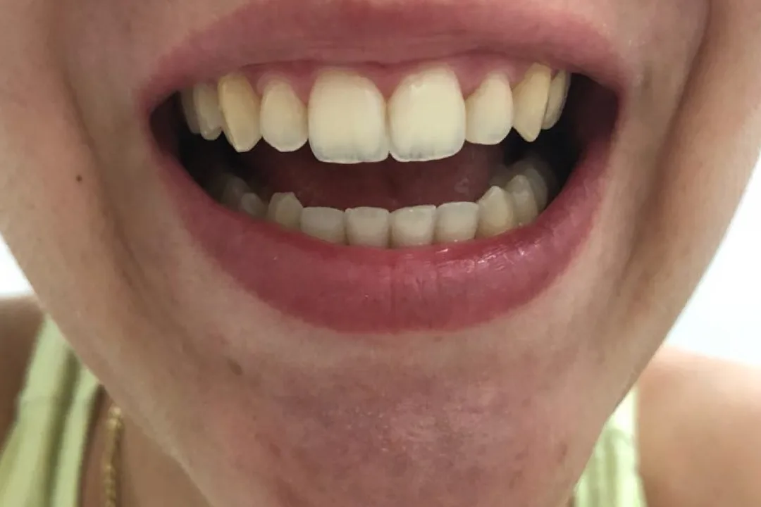 Antes - Clareamento Dental