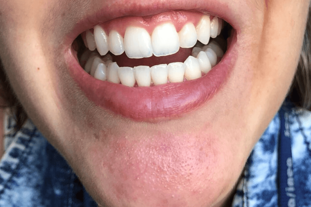 Depois - Clareamento Dental