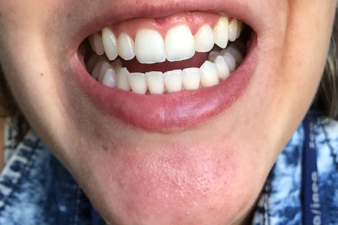 Depois - Clareamento Dental