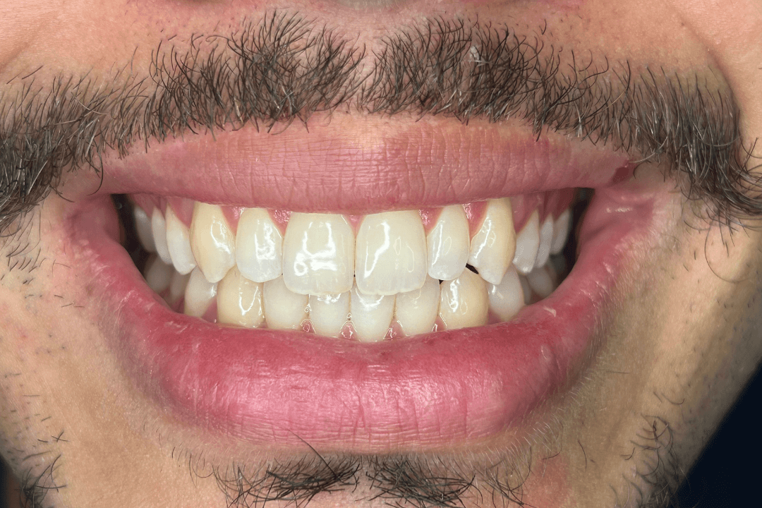 Antes - Clareamento Dental