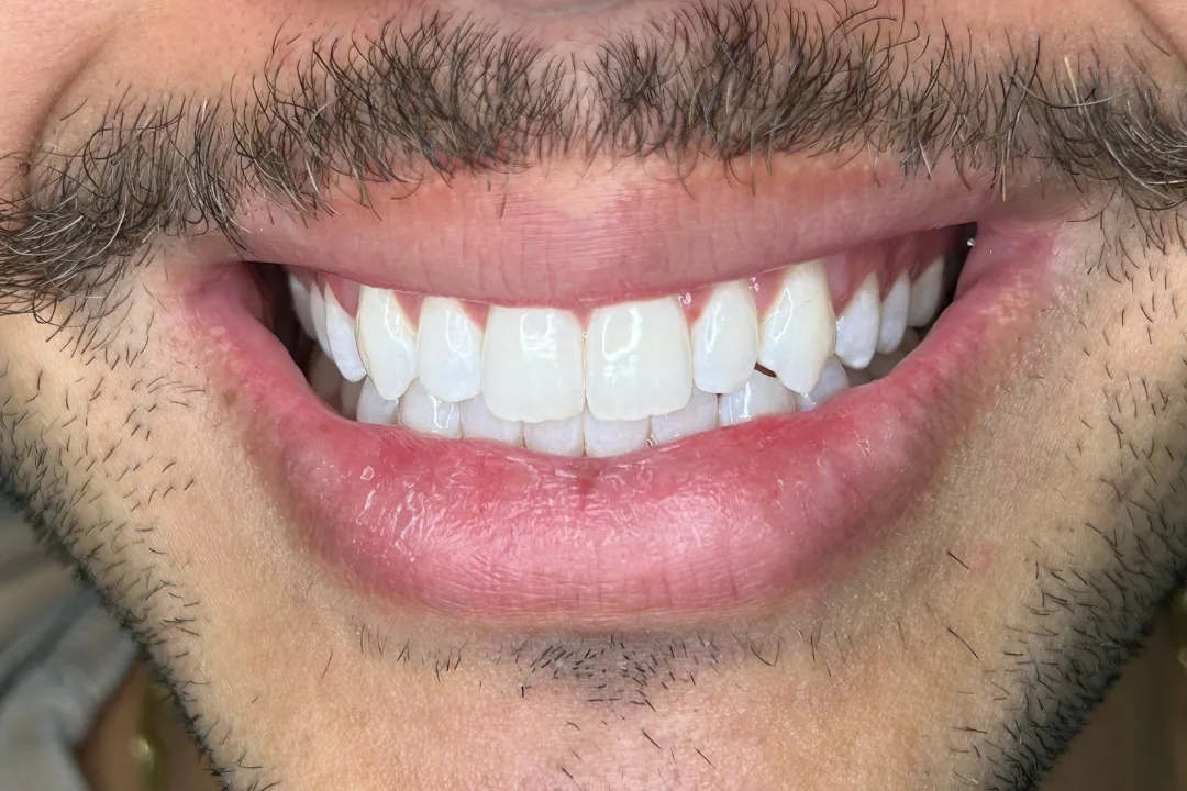 Depois - Clareamento Dental
